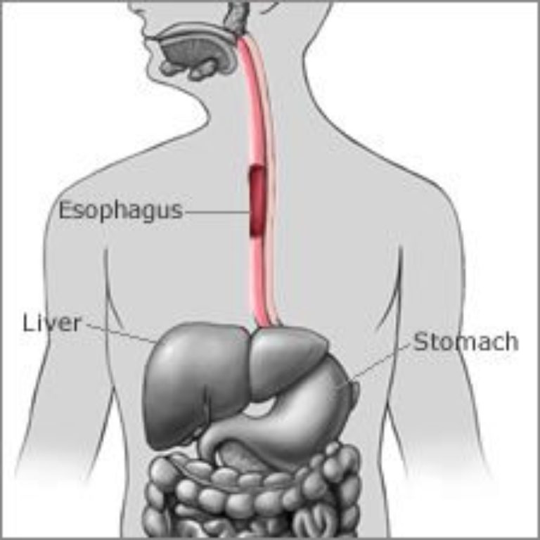 Barrett’s Esophagus | Acadiana Gastroenterology Associates