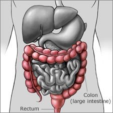 What are the Effects of Crohns Disease on the Body?