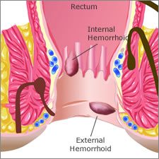 prolapsed hemorrhoid vs external